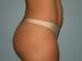 Liposuction Patient 03 - After Thumbnail 