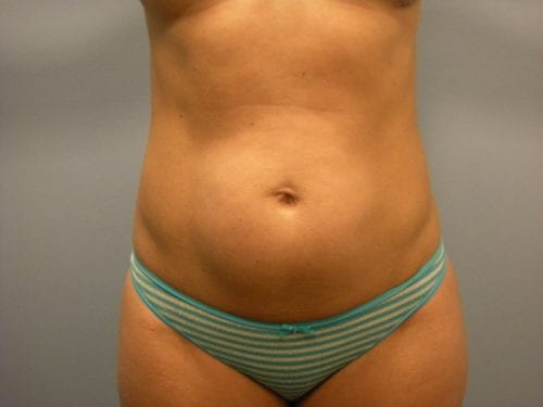 Liposuction Patient 03 - Before Thumbnail