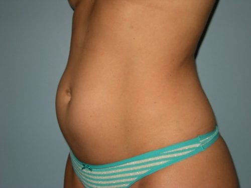 Liposuction Patient 03 - Before 