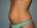 Liposuction Patient 03 - Before Thumbnail 