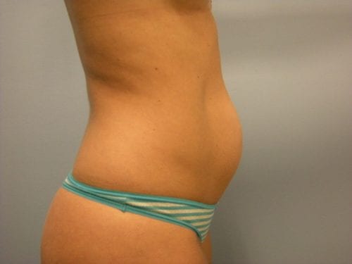 Liposuction Patient 03 - Before 2