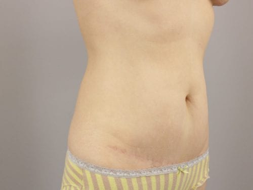 Liposuction Patient 04 - After 