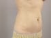 Liposuction Patient 04 - After Thumbnail 