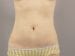 Liposuction Patient 04 - After Thumbnail 