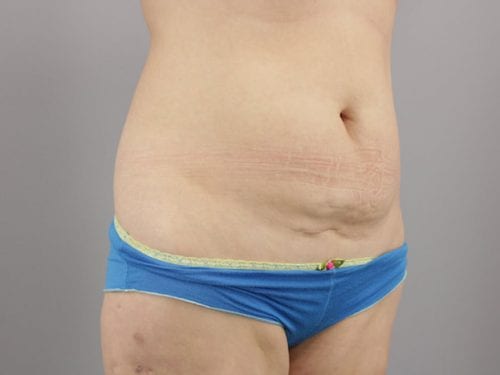 Liposuction Patient 04 - Before 