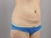 Liposuction Patient 04 - Before Thumbnail 
