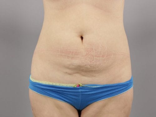 Liposuction Patient 04 - Before Thumbnail