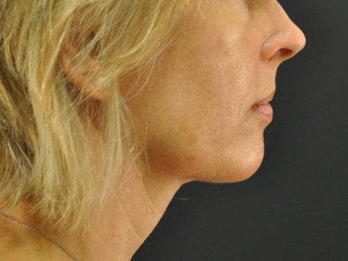 Liposuction Patient 05 - After Thumbnail