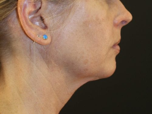 Liposuction Patient 05 - Before Thumbnail