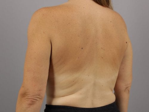 Liposuction Patient 06 - After 