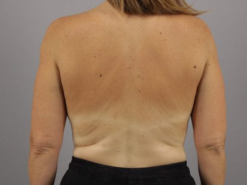 Liposuction Patient 06 - After Thumbnail