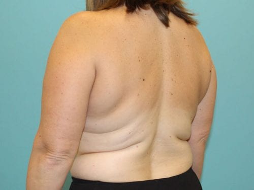 Liposuction Patient 06 - Before 