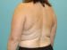 Liposuction Patient 06 - Before Thumbnail 