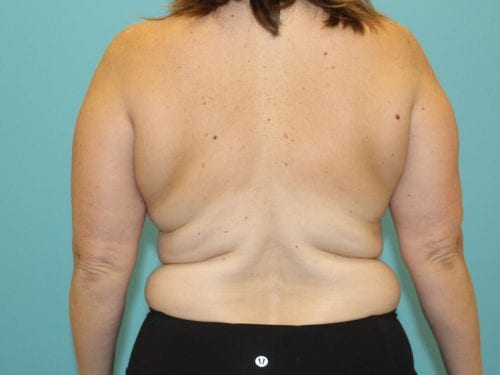 Liposuction Patient 06 - Before Thumbnail