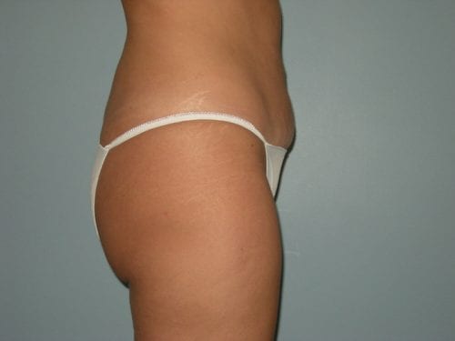 Liposuction Patient 07 - After 