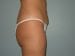 Liposuction Patient 07 - After Thumbnail 