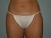 Liposuction Patient 07 - After Thumbnail 