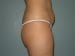 Liposuction Patient 07 - Before Thumbnail 