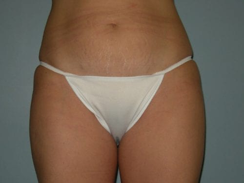 Liposuction Patient 07 - Before Thumbnail