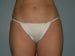 Liposuction Patient 07 - Before Thumbnail 