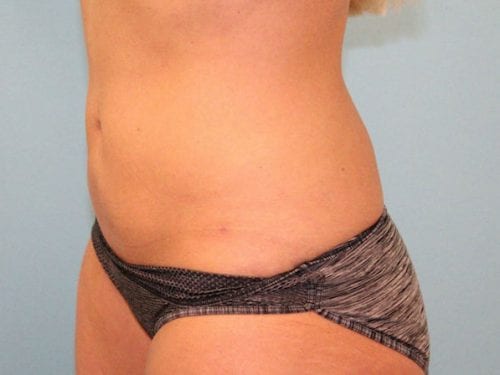 Liposuction Patient 08 - After 