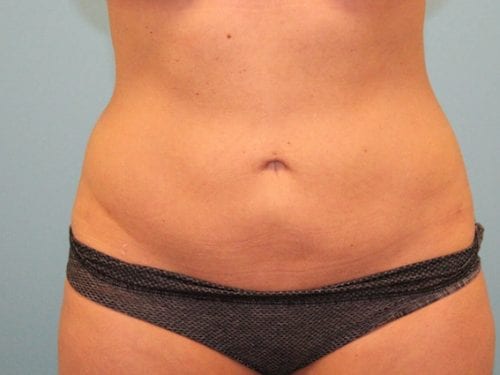 Liposuction Patient 08 - After Thumbnail
