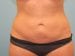 Liposuction Patient 08 - After Thumbnail 
