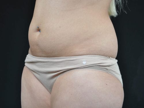 Liposuction Patient 08 - Before 