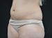 Liposuction Patient 08 - Before Thumbnail 