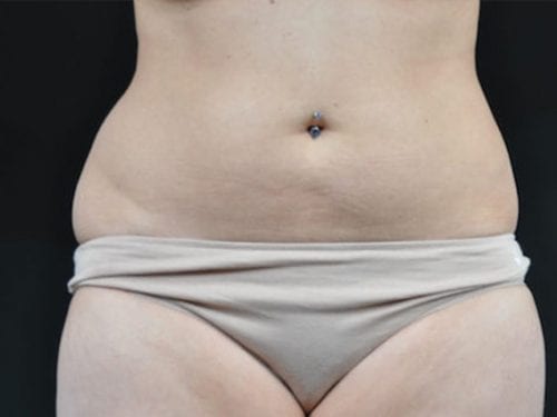 Liposuction Patient 08 - Before Thumbnail