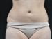 Liposuction Patient 08 - Before Thumbnail 