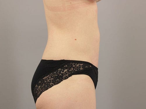 Liposuction Patient 11 - After Thumbnail