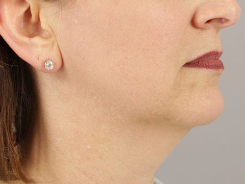 Liposuction Patient 12 - Before Thumbnail