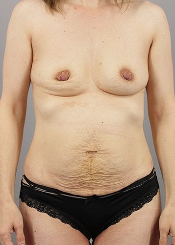 Mommy Makeover Patient 10 - Before Thumbnail