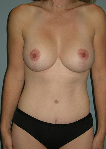 Mommy Makeover Patient 07 - After Thumbnail