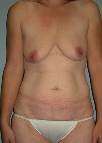 Mommy Makeover Patient 07 - Before Thumbnail