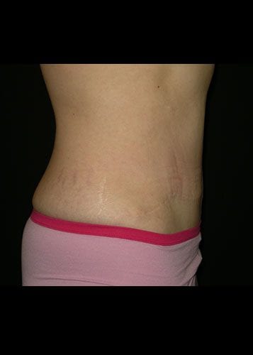 Mommy Makeover Patient 08 - After 3