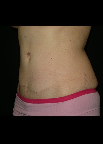 Mommy Makeover Patient 08 - After 2