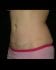 Mommy Makeover Patient 08 - After Thumbnail 