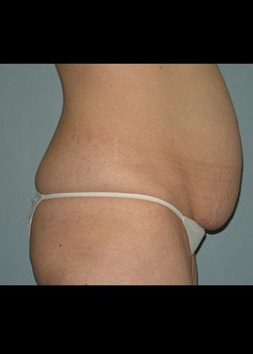 Mommy Makeover Patient 08 - Before 3