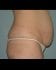 Mommy Makeover Patient 08 - Before Thumbnail 