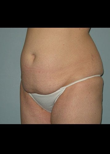 Mommy Makeover Patient 08 - Before 2