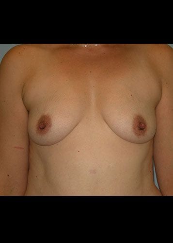 Mommy Makeover Patient 08 - Before Thumbnail