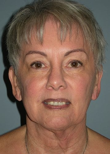 Neck Lift Patient 01 - Before Thumbnail