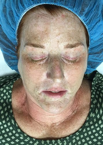 Photofacial 01 - After Thumbnail