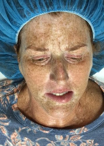 Photofacial 01 - Before Thumbnail