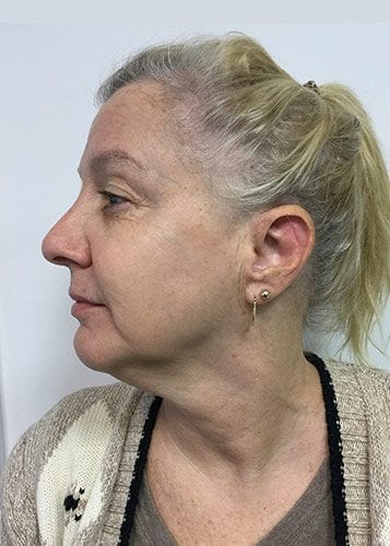 Photofacial 02 - After 