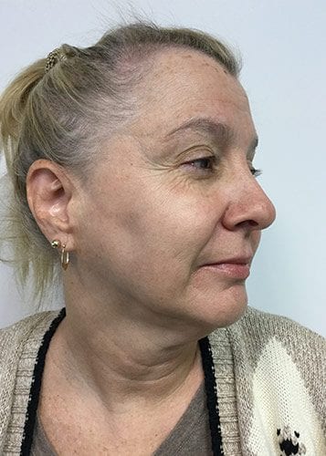 Photofacial 02 - After 2