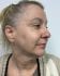 Photofacial 02 - After Thumbnail 