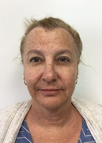 Photofacial 02 - Before Thumbnail